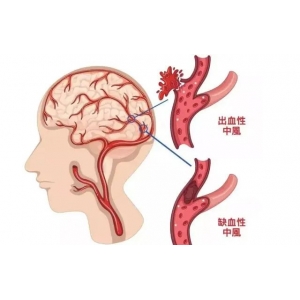 為什么中國(guó)腦梗越來(lái)越多，美國(guó)卻在減少？醫(yī)生：主要原因有這3點(diǎn)